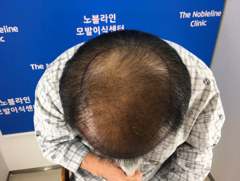 수술 어렵다는 가는모발입니다. 드디어 모발이식 했습니다.