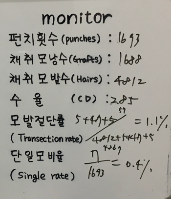 4812모 m자+옆머리 이식 4개월 후기