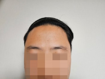 모원성형외과 M자 모발이식 +3일 설레는 마음으로 작성해봅니다