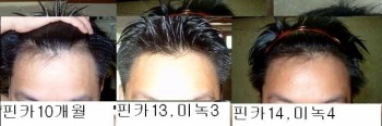 핀카 14 미녹 4개월 경과글