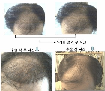 수술후 거의5개월